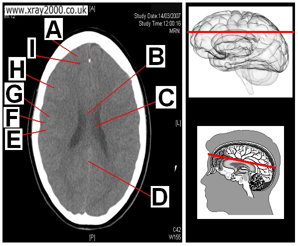 AXIAL SECTION 3.JPG